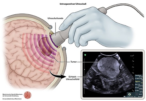 Schematische Darstellung einer Ultraschallsonde am Gehirn mit zugehörigem Echtzeit-Ultraschallbild eines Hirntumors.