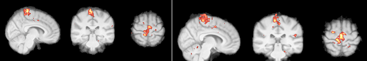 Darstellung von funktionellen und metabolischen MRT-Gehirnbildern mit farblich markierten Arealen, die unterschiedliche Aktivitäts- und Stoffwechselregionen des Gehirns zeigen.