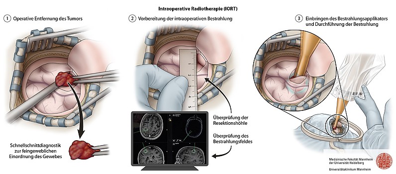 Dreischrittige schematische Darstellung einer intraoperativen Radiotherapie: Tumorresektion, Prüfung der Resektionshöhle und Einbringen eines Bestrahlungsapplikators.
