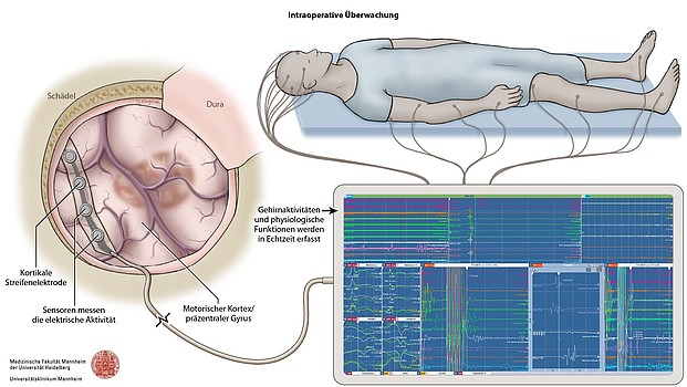 Schematische Darstellung des intraoperativen neurophysiologischen Monitorings mit Elektroden am Patienten, kortikaler Streifenelektrode und Echtzeitdarstellung neurophysiologischer Signale.