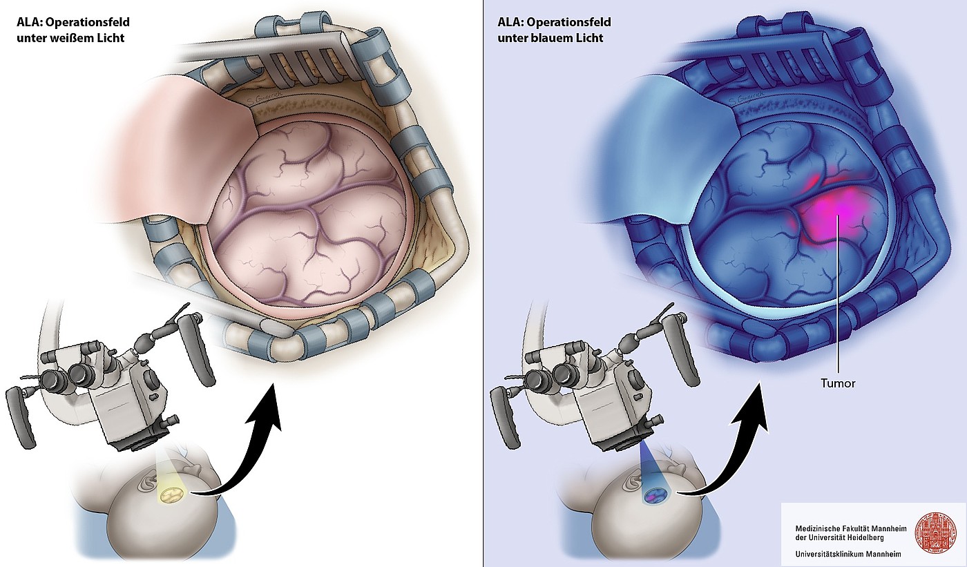 Vergleich eines neurochirurgischen Operationsfeldes unter weißem Licht und unter blauem Licht; unter 5-ALA fluoresziert Tumorgewebe rosa bis rot.