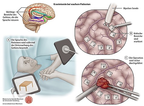Schematische Darstellung einer Wachoperation: Sprachtestung am wachen Patienten, direkte kortikale Stimulation, Markierung sprachkritischer Areale und anschließende Tumorresektion.