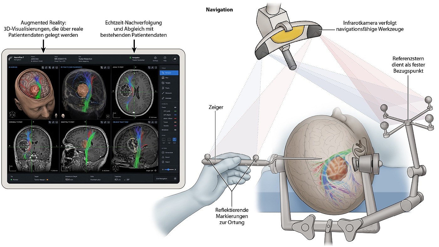 Schematische Darstellung der Neuronavigation bei einer Hirntumoroperation mit Infrarotkamera, navigiertem Instrument und patientenspezifischer MRT- und Faserbahn-Darstellung.